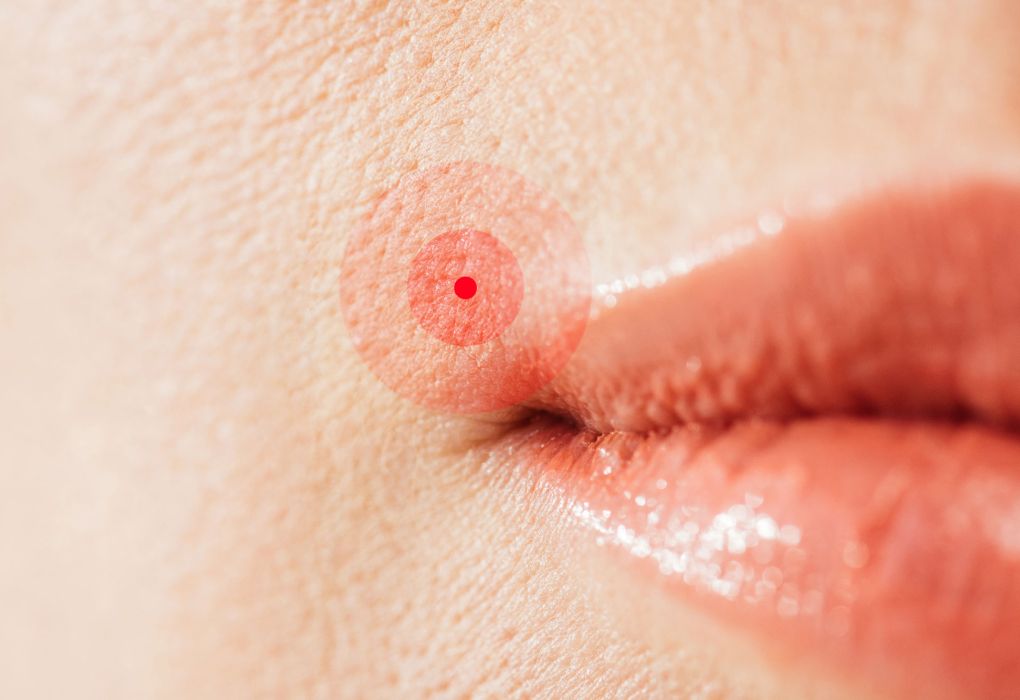 Lippen mit deutlich sichtbarem Herpesbläschen am Mundrand
