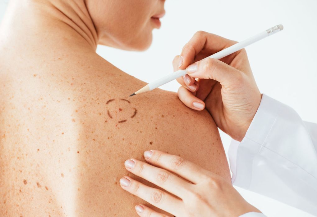 Arzt untersucht die Haut am Rücken eines Patienten mit einem Stift zur Markierung verdächtiger Stellen