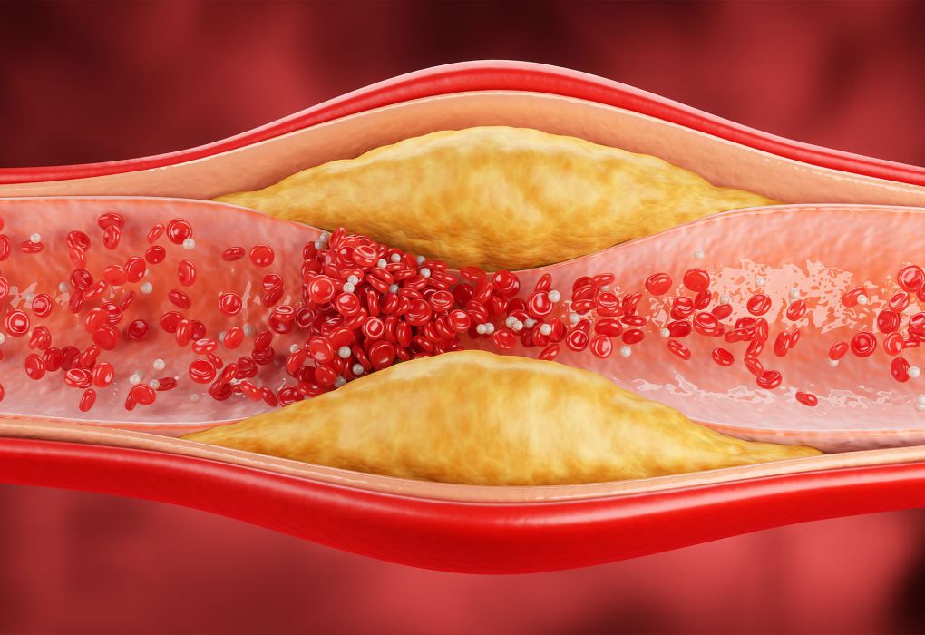 Grafische Darstellung einer Arterie mit gelblichen Ablagerungen im Inneren.
