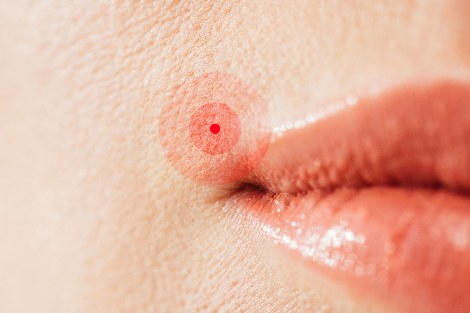 Lippen mit deutlich sichtbarem Herpesbläschen am Mundrand