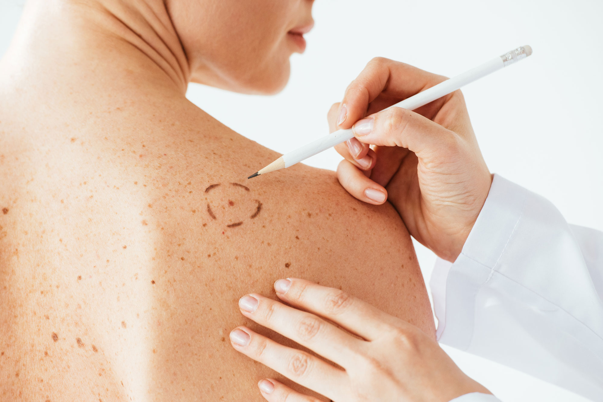 Arzt untersucht die Haut am Rücken eines Patienten mit einem Stift zur Markierung verdächtiger Stellen